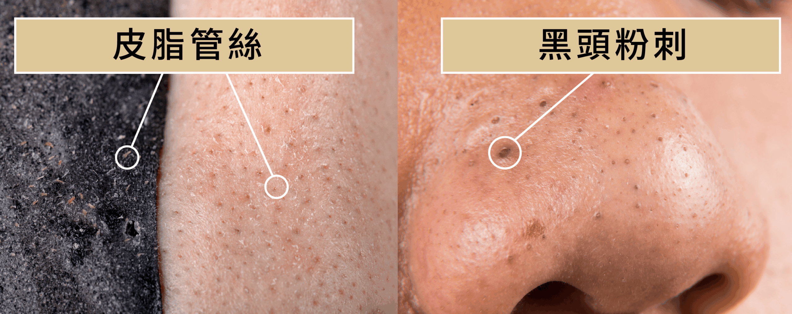 Read more about the article 鼻子黑頭粉刺可以天天清嗎？ 怎麼清比較好？