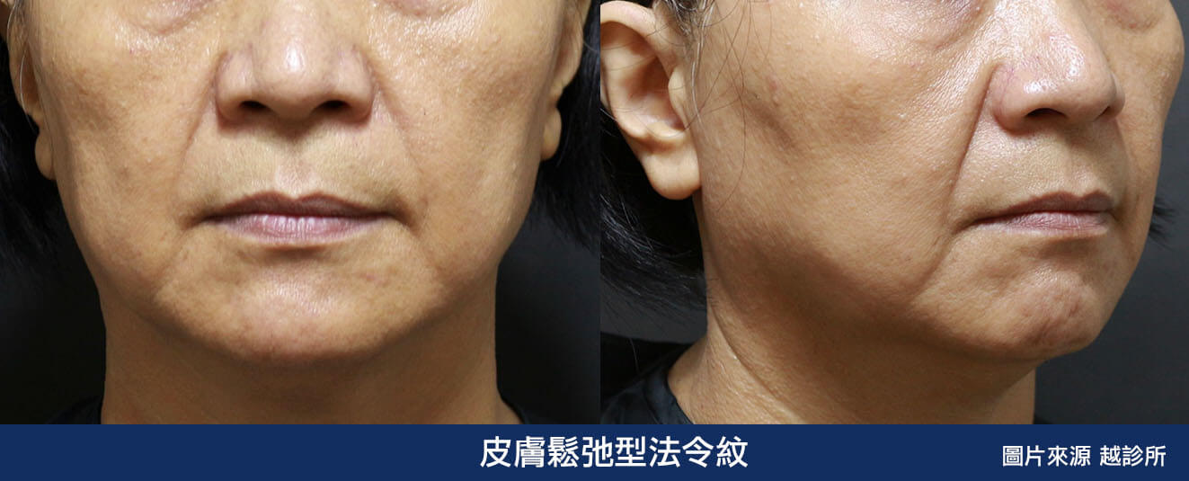 皮敷鬆弛型法令紋