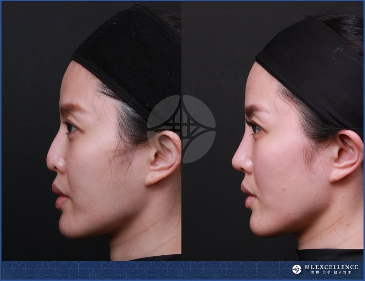 越L’EXCELLENCE隆鼻案例