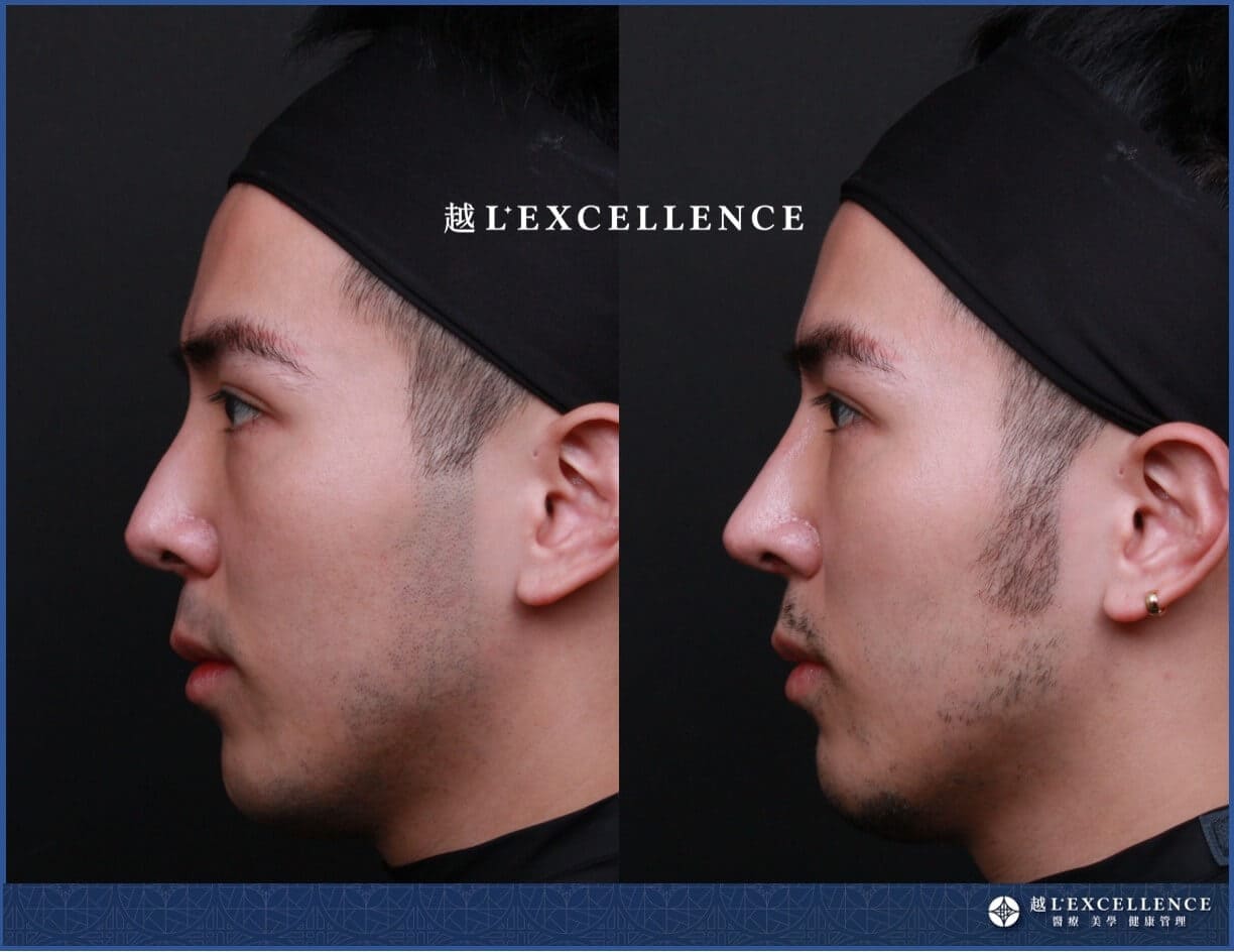 越L’EXCELLENCE隆鼻案例