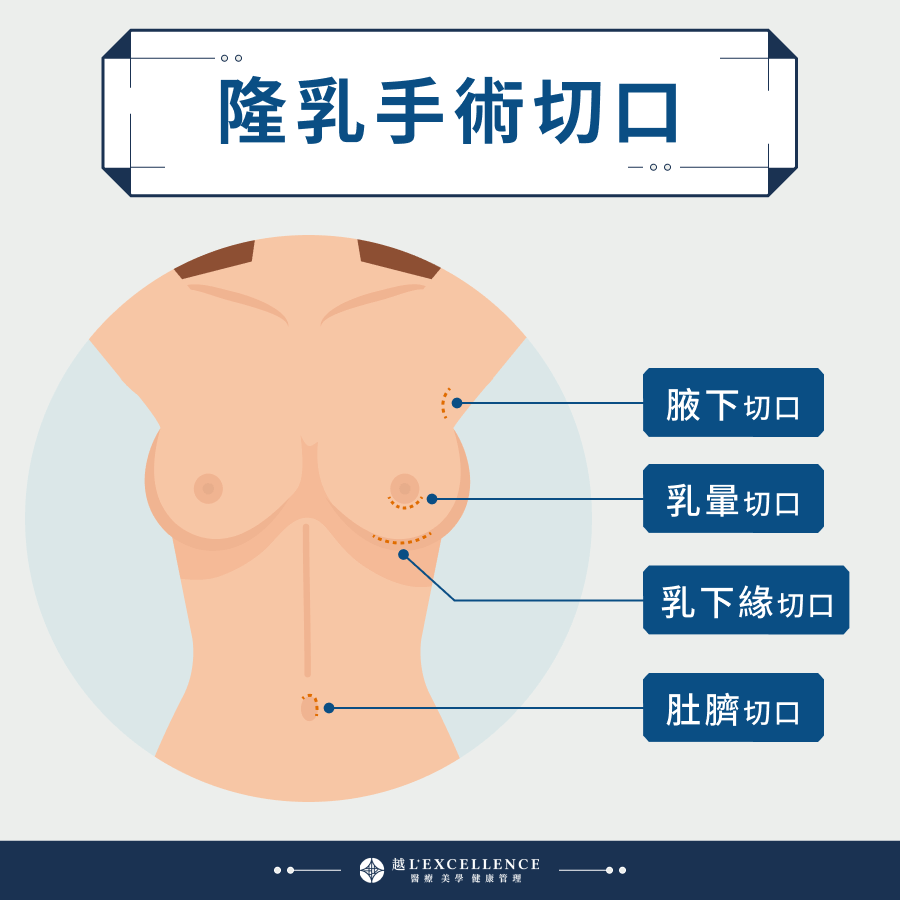隆乳手術切口