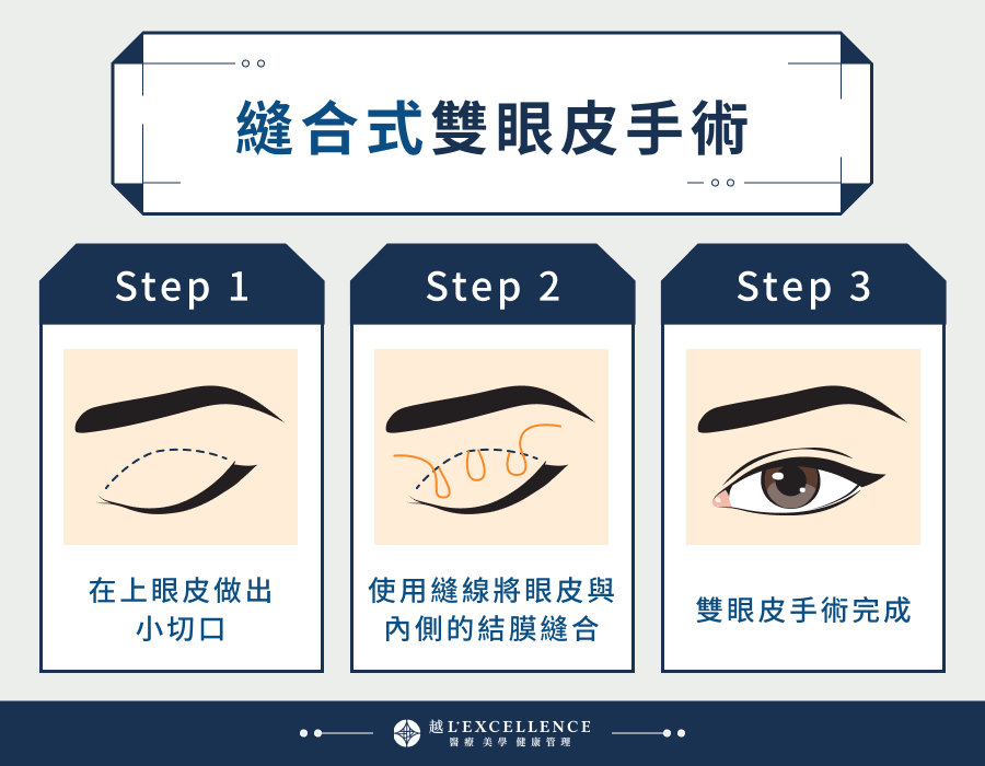 縫合式雙眼皮手術