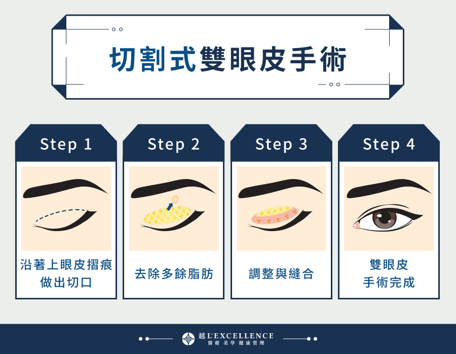 切割式雙眼皮手術