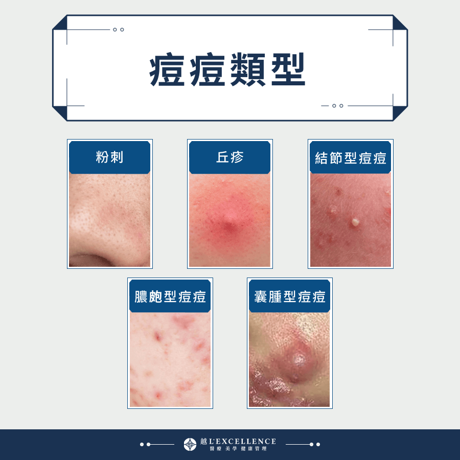 痘痘類型