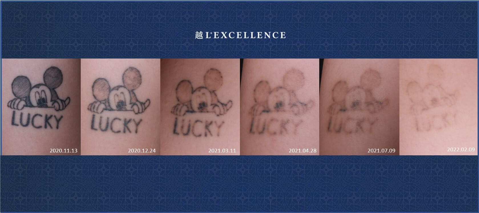 皮秒雷射功效:皮秒除刺青