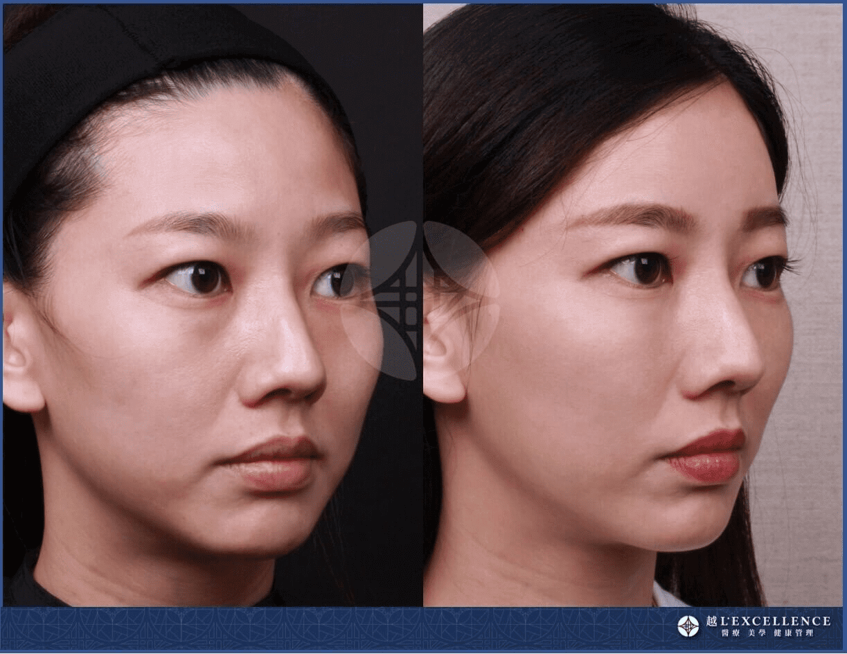 真童妍拉提術案例