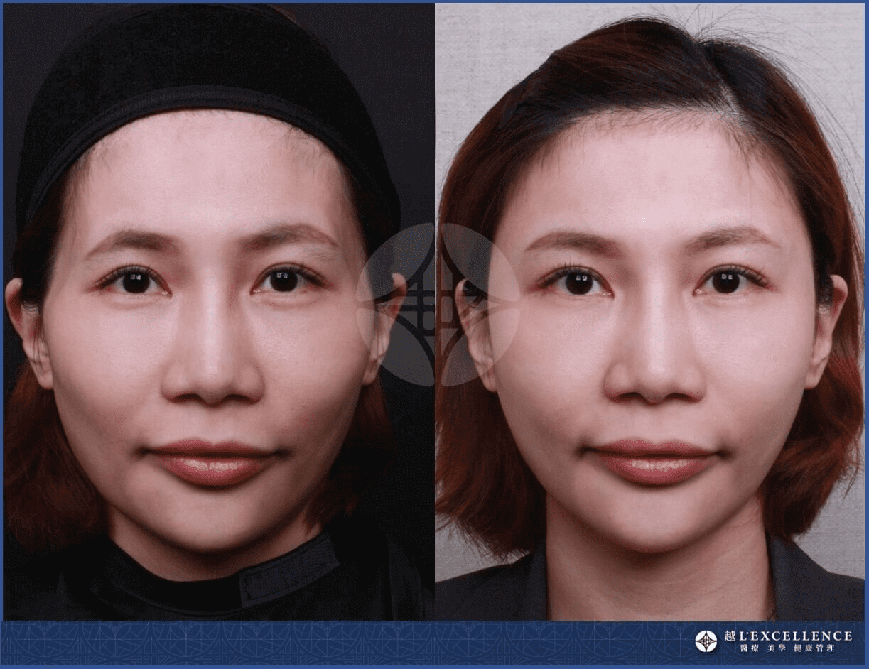 洢蓮絲實際案例