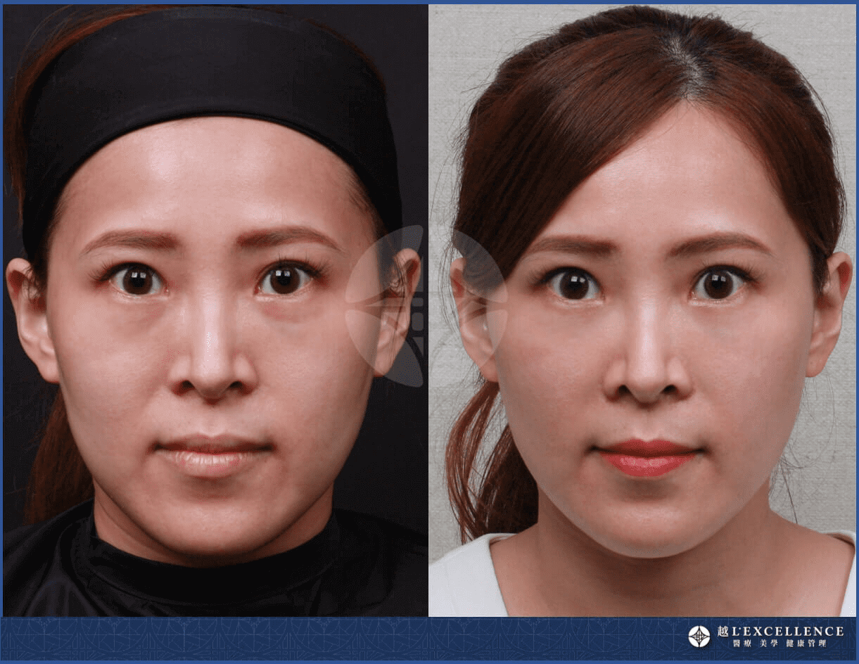 洢蓮絲實際案例