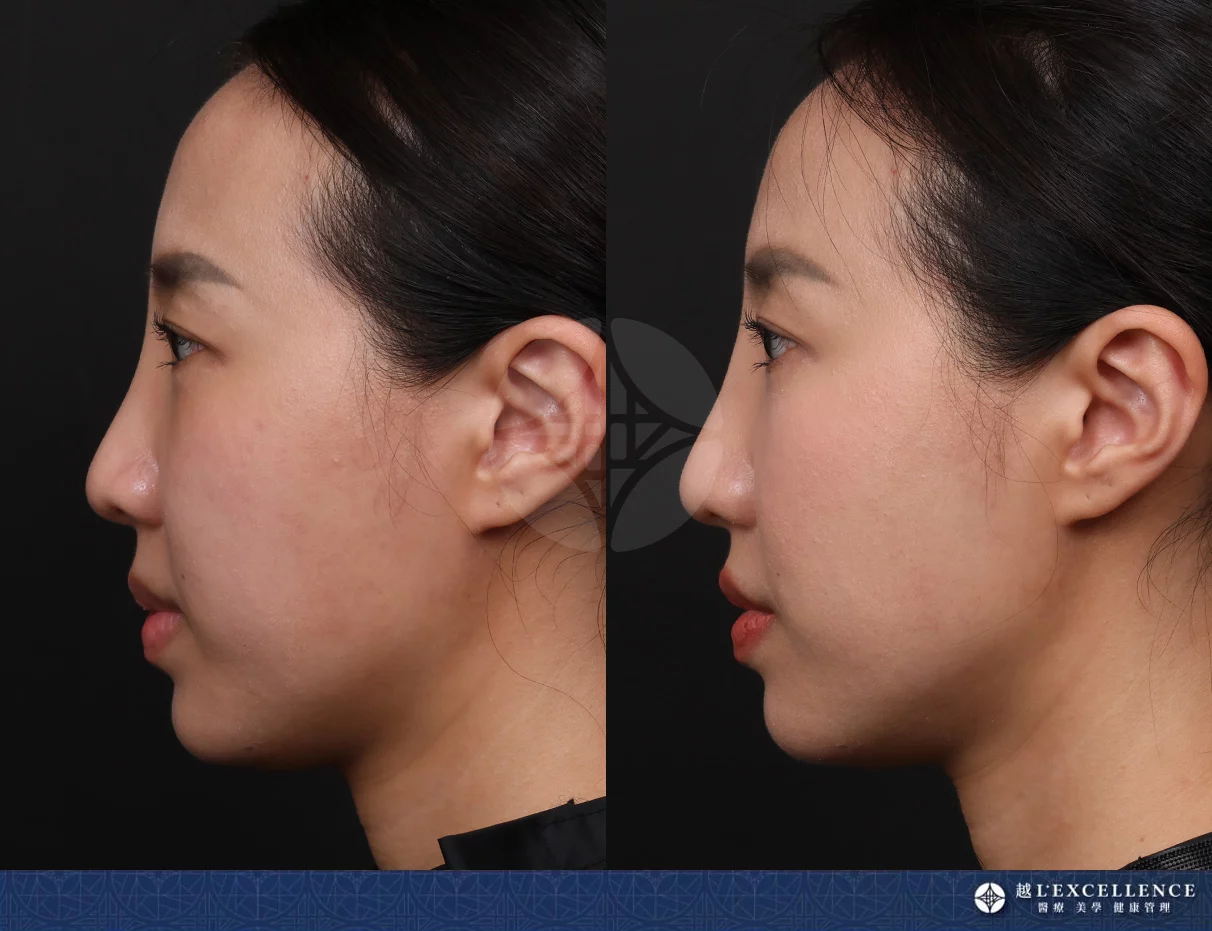 越診所9732 鼻雕 左