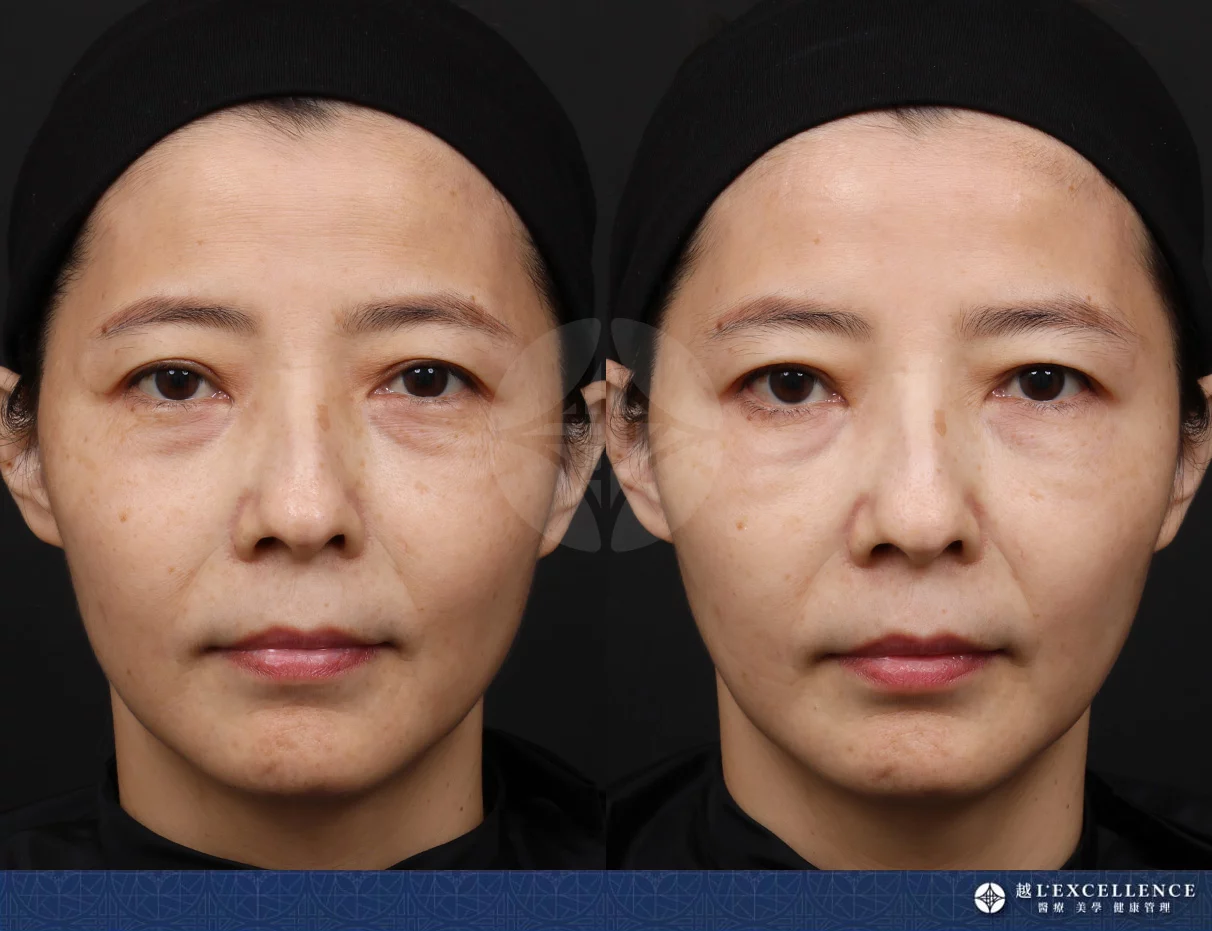 EMFACE菲斯波是什麼？誰適合？價錢？做幾次有感？推薦原因一次看  